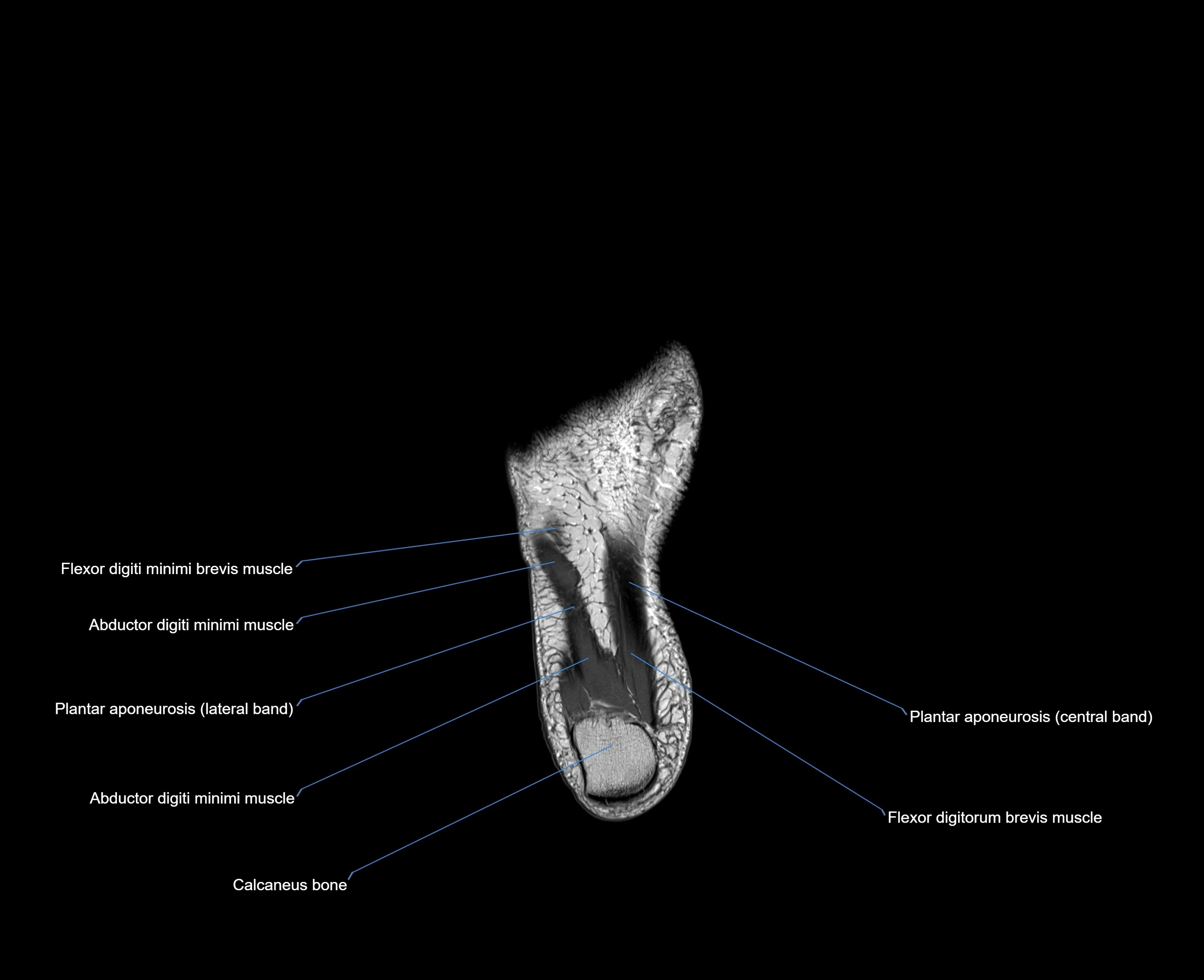 MRI foot coronal cross sectional anatomy 3T  radiology  image-img-00001-00030.webp